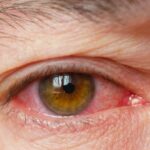 Herpes ocular pode levar à cegueira, alerta especialista